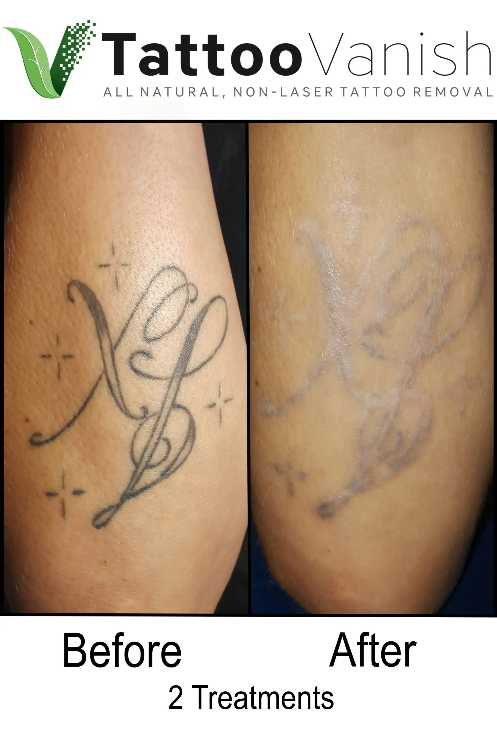 Best Tattoo Removal in Miami
