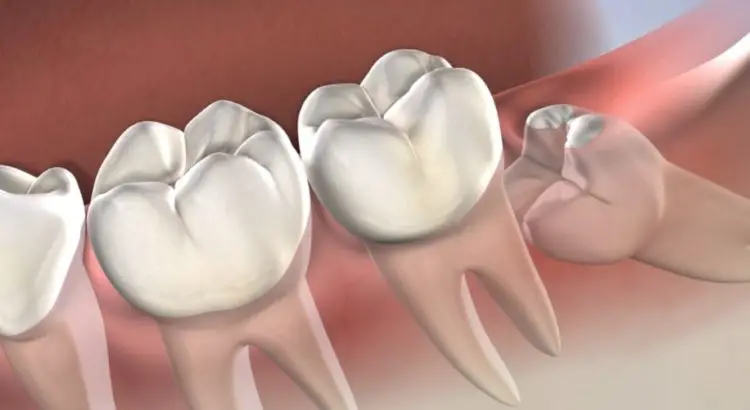 How Medicare Works with Wisdom Teeth Removal