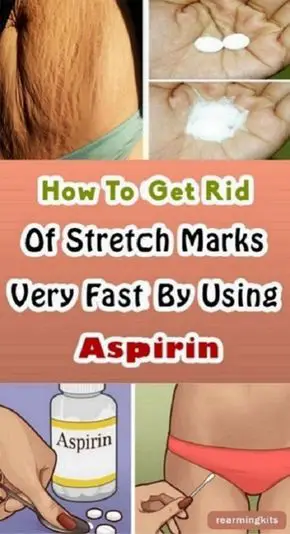 How To Get Rid Of Stretch Marks Very Fast By Using Aspirin ...