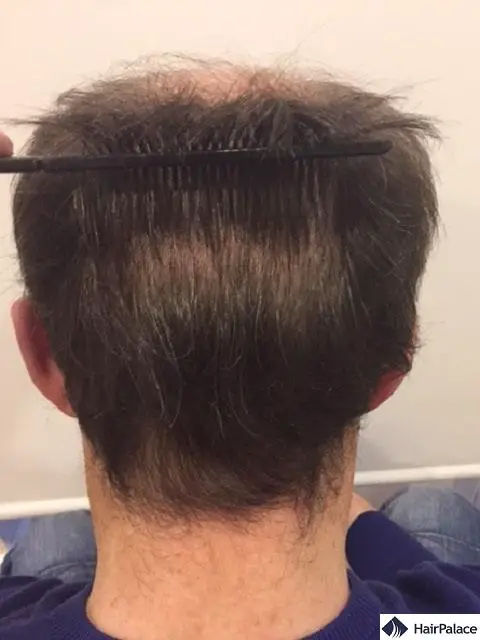 Tomâs Two Hair Transplant Sessions